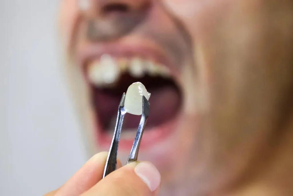 دلیل افتادن روکش دندان و مدیریت آن