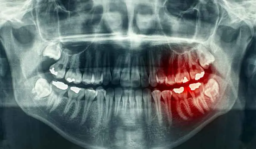 تشخیص-عفونت-دندان-در-تصاویر-رادیولوژی