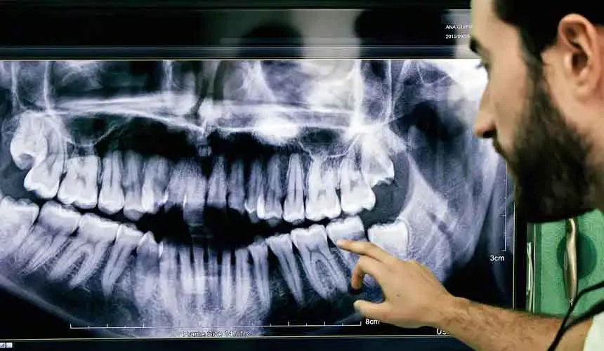 اهمیت عکس رادیولوژی دندان