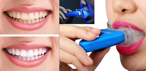 دستگاه‌ های سفید کننده دندان