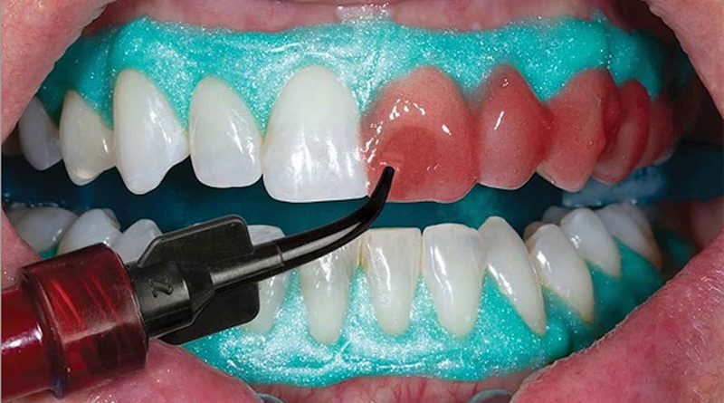 انواع بلیچینگ دندان