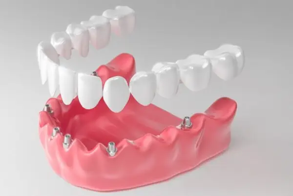 انواع دندان مصنوعی