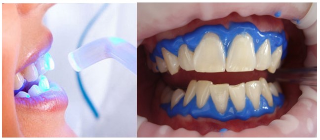 سیستم‌های بلیچینگ دندان