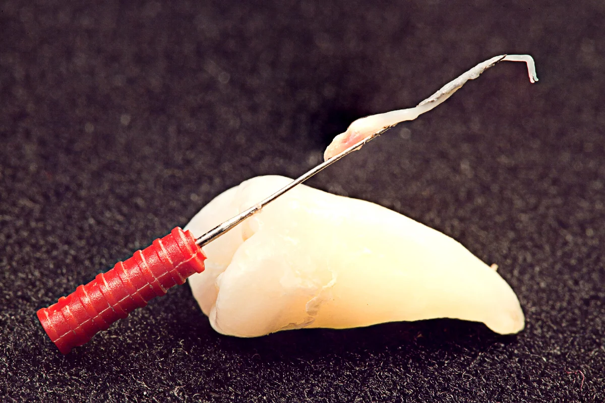 اهمیت شستشوی کامل کانال ریشه