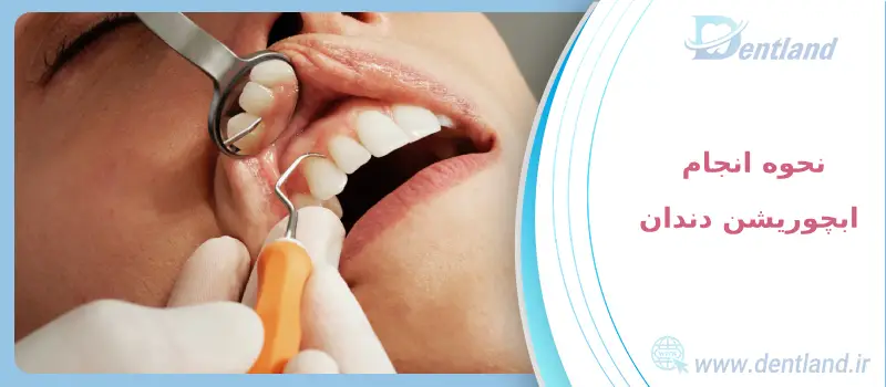 آبچوریشن دندان چیست ؟